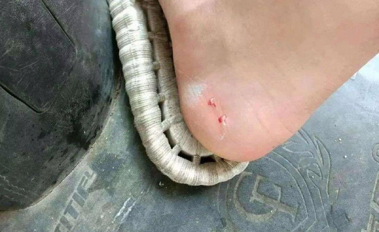 （三亚被蛇咬了）